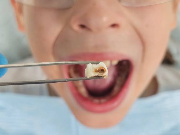 Best Emergency Treatment for Toothache in Fort Mckinley, OH
